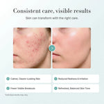 Lepique Hypochlorous Acid Acne Spray