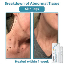 Load image into Gallery viewer, Bikenda® 🔥🔥 Non-Invasive Mole and Wart Removal Laser Pen
