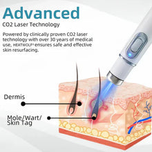 Load image into Gallery viewer, Bikenda® 🔥🔥 Non-Invasive Mole and Wart Removal Laser Pen
